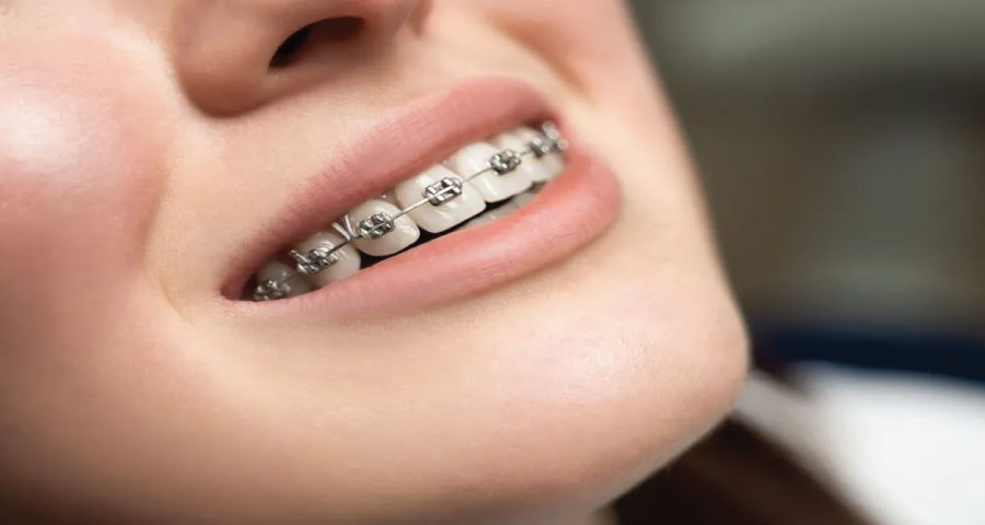 Guide to Understanding Braces